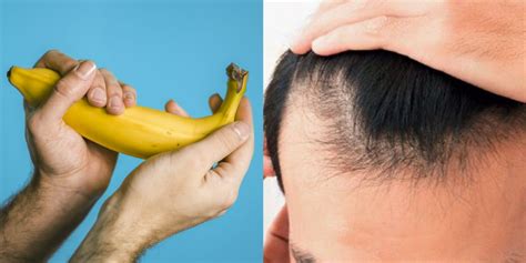 masterbation and baldness|Hair loss .